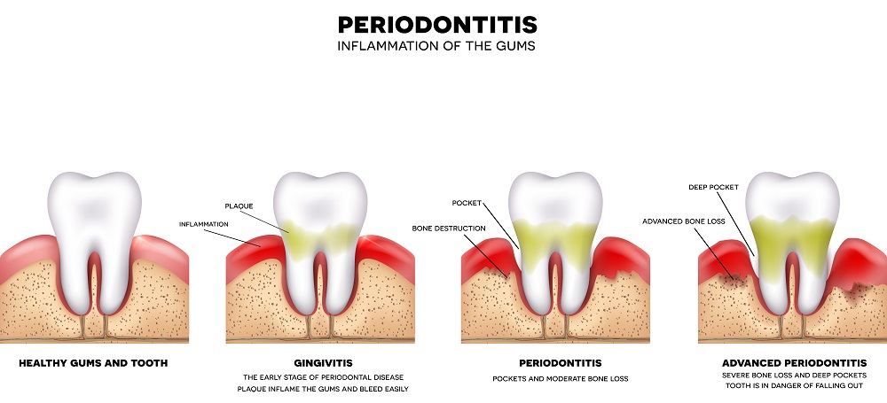 Periodontitis (pericementitis).