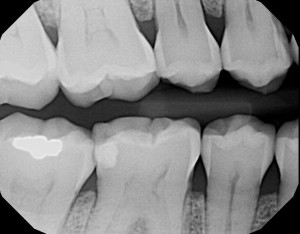 Gulf Coast Endodontics Outstanding Case Report 1