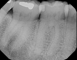 Gulf Coast Endodontics Outstanding Case Report 2