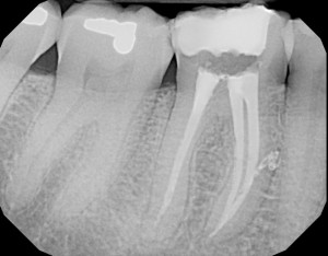 Gulf Coast Endodontics Outstanding Case Report 3