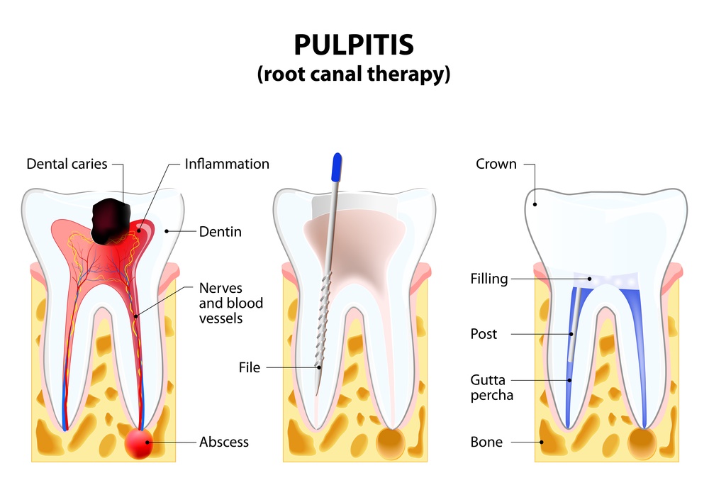 Pulpitis, root canal therapy.